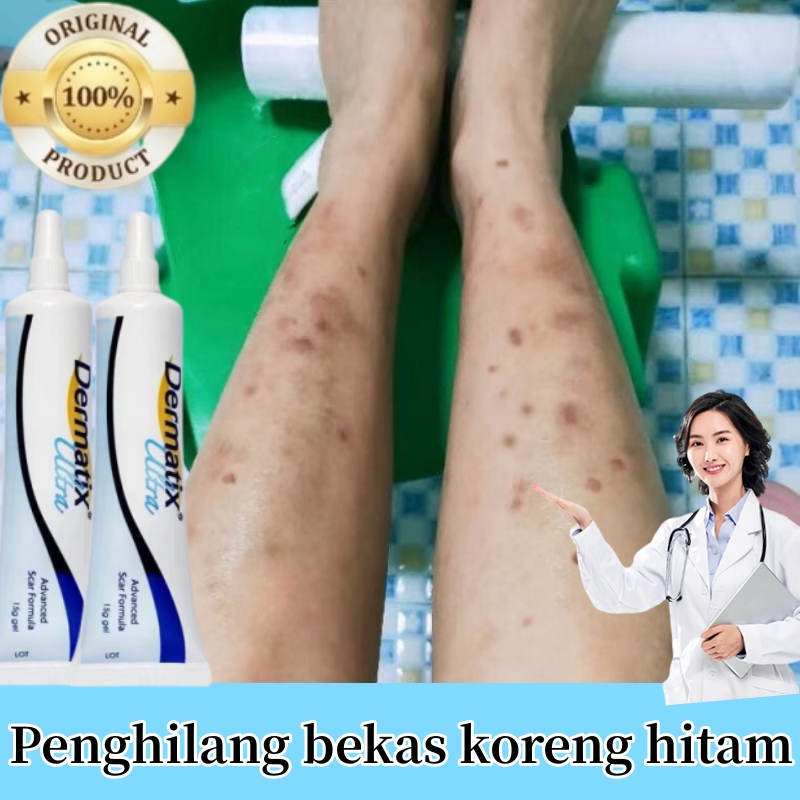 Jual Dermatix Scar Formula Gel Cream Salep Penghilang Bekas Luka Keloid