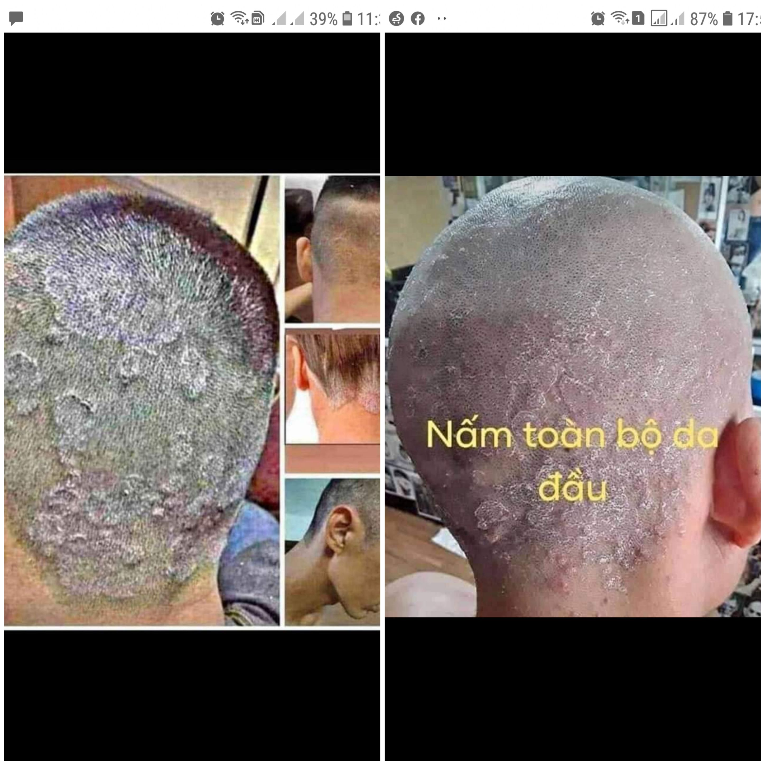 Viêm da Lợi An giảm các vấn đề về nấm da