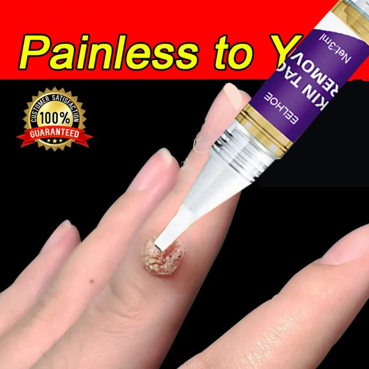  TAGS&MOLES REMOVER Gel Tẩy Nốt Ruồi Tàn Nhang Mụn Cóc Mụn Thịt Mụn Cơm Sẹo Lồi 