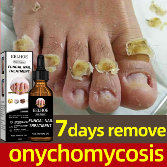 Serum sửa chữa móng tay  nấm móng Loại bỏ nấm móng Dưỡng móng Chăm sóc tay và chân/30ml tay chân loại bỏ nấm móng tay