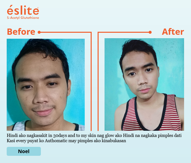 s acetyl glutathione before and after Your skin deserves to be taken care of. Experience your consistent skin  Improvement with éslite! 🩵 Have your very own éslite experience now!  Available at Shopee and Lazada! #Eslite #EsliteSAcetylGlutathione  #GlutathionePhilippines #Glutathione # main image 1