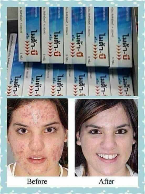Kem đặc khắc phục nấm lanǥ ƅen Myda-B 