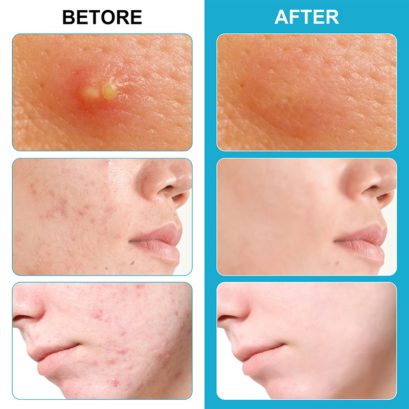 BELLE Mặt các bản vá lỗi cho mụn nhọt microneedles khô vá Blemish bao gồm dán 6 đếm vô hình chăm sóc tại chỗ hấp thụ tất cả các ngày