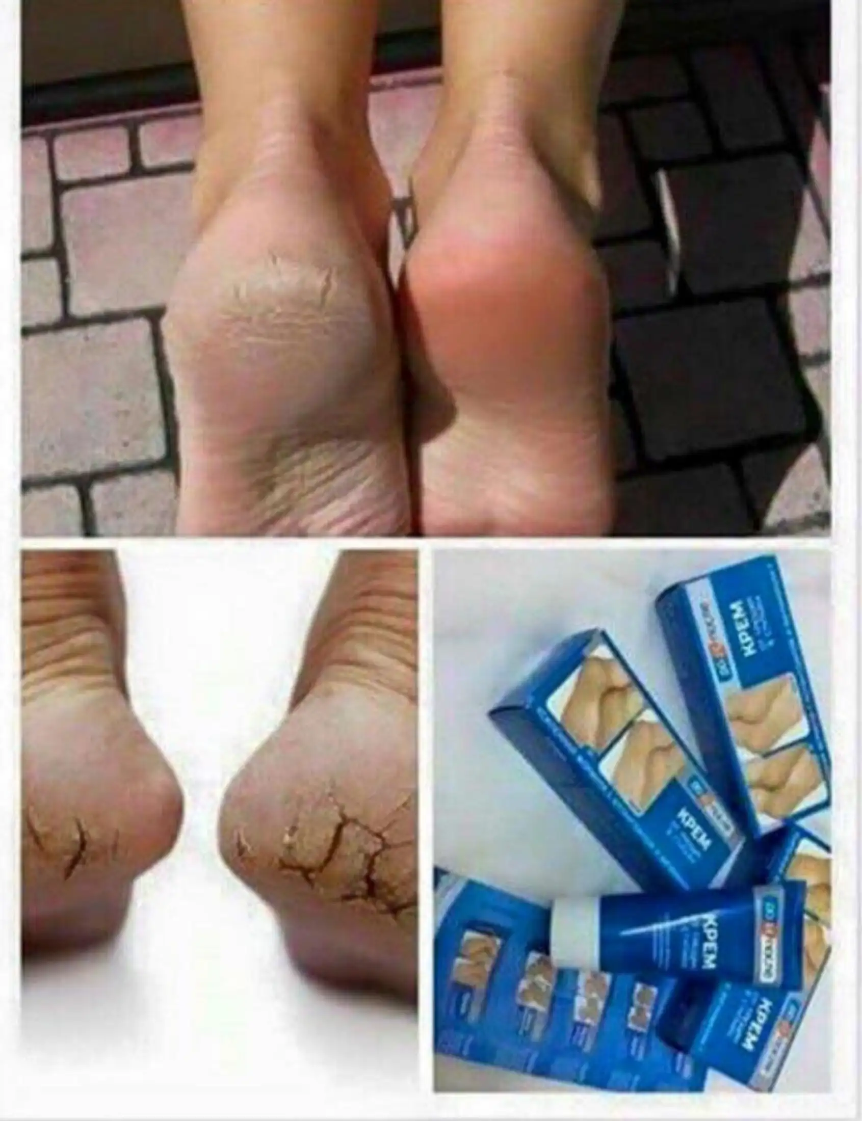 leg crack removal cream