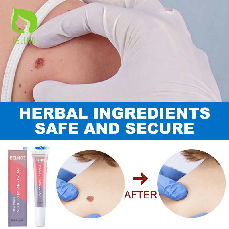 Nevus Kem tẩy mặt cơ thể vết sẹo mụn trứng cá sửa chữa Thuốc mỡ loại bỏ nốt ruồi Thuốc mỡ