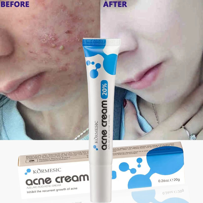  AZELAIC ACID Kem chấm mụn bỏ các loại mụn mụn đầu đen,mụn ở tuổi dậy thì,loại bỏ mụn bọc cho da dầu 