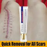 Kem mờ sẹo mờ thâm sẹo lồi sẹo lõm sẹo do mụn và giảm rạn da hiệu quả 30ml nhanh chóng làm mờ sẹo lồi sẹo lõm