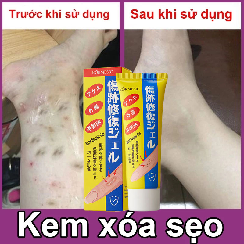 [Loại bỏ sẹo triệt để] Kem xóa sẹo nhanh chóng, vết sẹo trầy xước, vết bỏng, vết thương sau phẫu thuật, vết rạn da tăng