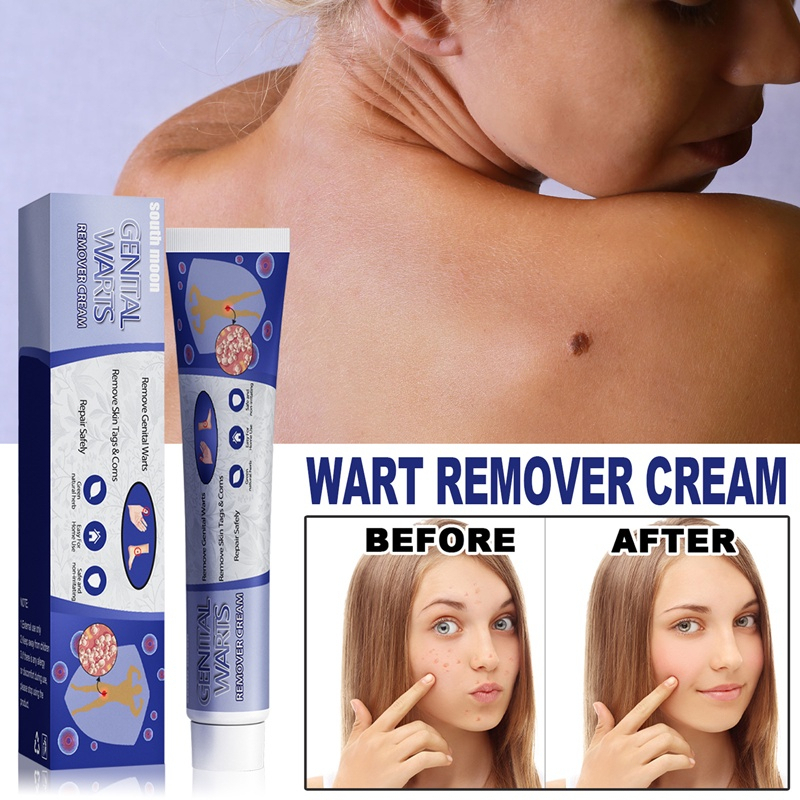 ️100% Chính Hãng️kem xoá mụn cóc,Tẩy nốt ruồi, mụn thịt, loại bỏ mụn cóc thông thường,mụn đá, mụn cơm,mụn cóc dạng sợi
