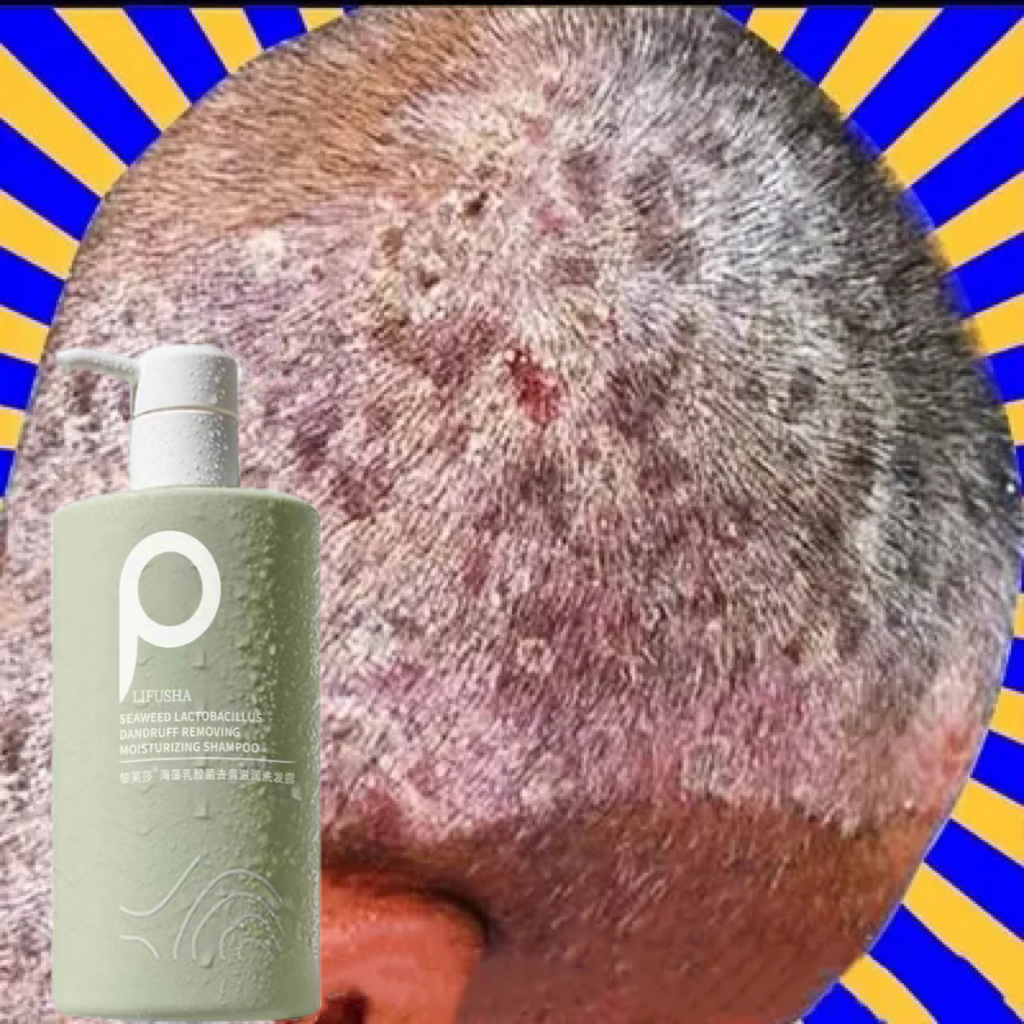  Dầu gội đầu muối biển dầu gội đầu loại bỏ gàu dầu gội loại bỏ tế bào chết dầu gội chống ngứa 500ml loại bỏ ngứa ngáy vảy nến hiệu quả làm sạch da đầu mạnh mẽ Sea salt shampoo 