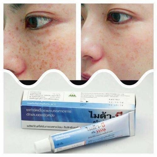 Kem đặc khắc phục nấm lanǥ ƅen Myda-B 