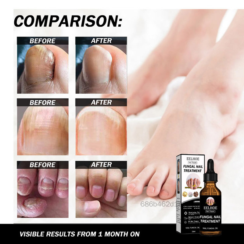 Nail Fungus Điều trị sửa chữa móng chân Essence Renewed bị hỏng móng DBS-VN