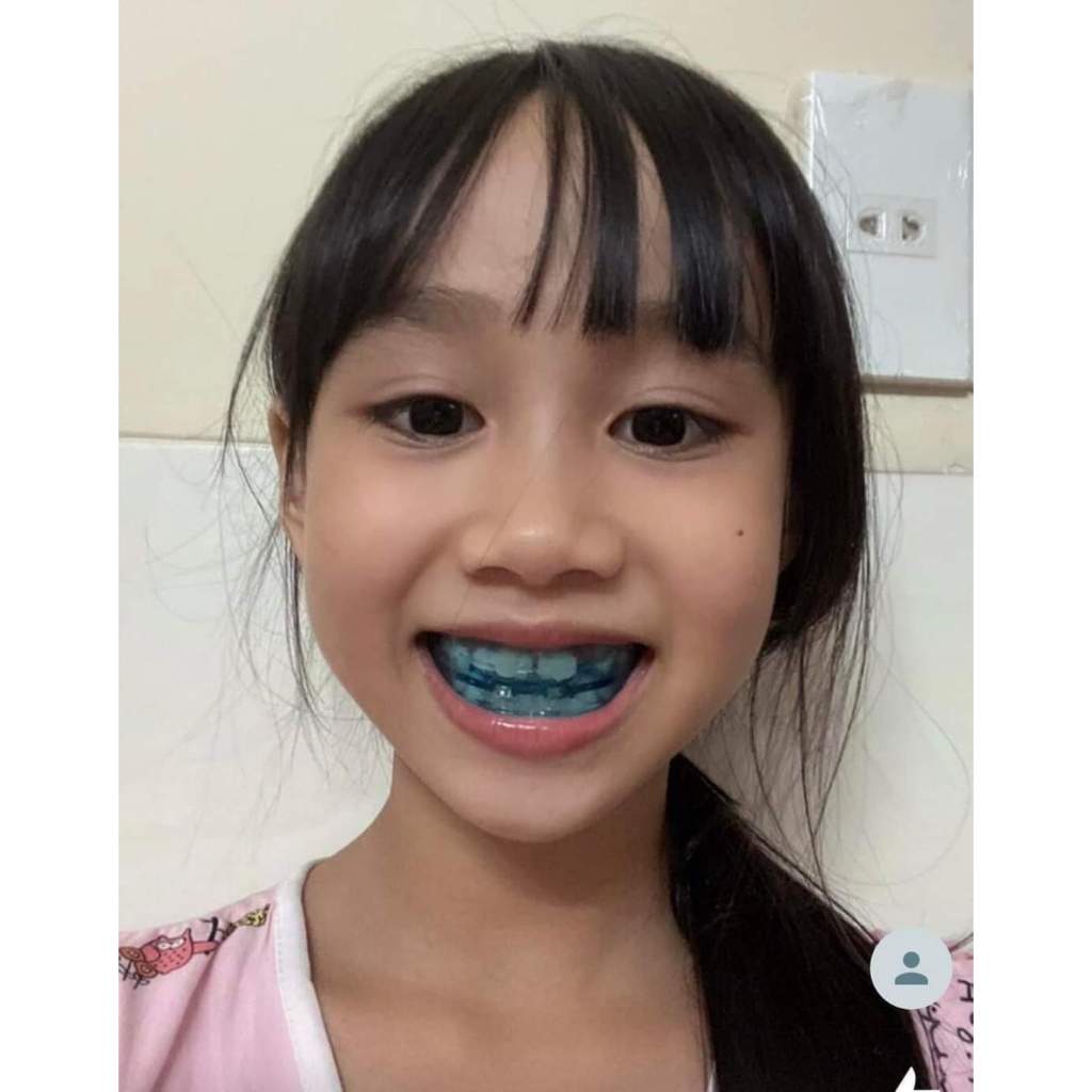 Khí cụ chỉnh nha-Hàm-trainer dành cho các bé từ 6-12 tuổi chỉnh khe thưa, khấp khểnh, răng hô, móm, khớp cắn ngược
