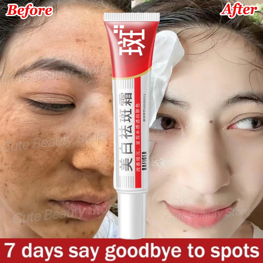 Effective Whitening Freckles Face Cream Remove Melasma Dark Spots Fade Melanin Acne Scars Anti-Aging