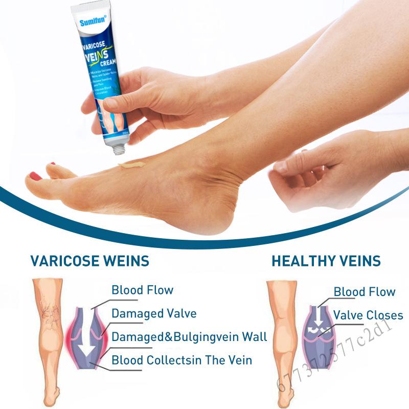 Varicose Veins Cream, Effective Varicose and Spider Veins Treatment Eliminate The Appearance Of Vari