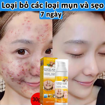 Kem chấm mụn hiệu quả hết mụn siêu tốc ngừa sẹo thâm dành cho da dầu nhờn,Kem giảm mụn chuyên sâu /30ml