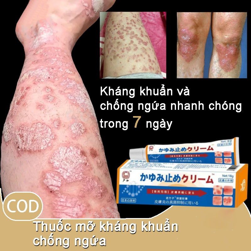 Nhật Bản Kem bôi vẩy nến viêm da kháng khuẩn đánh bay nấm da chống ngứa viêm da hắc lào lang ben mề 