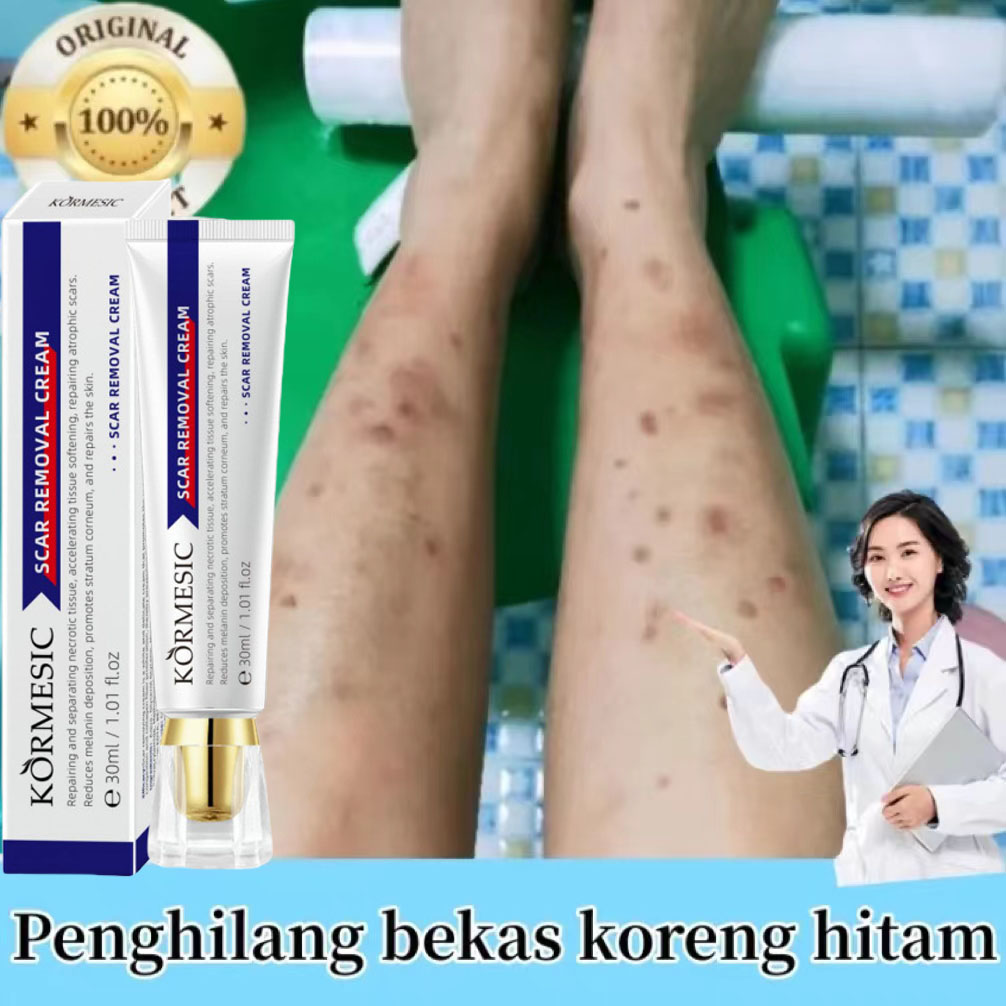 Kem khử thâm, xóa sẹo cũ, loại sẹo ở chân, sẹo côn trùng cắn, sẹo lồi, sẹo bỏng, bỏng nước
