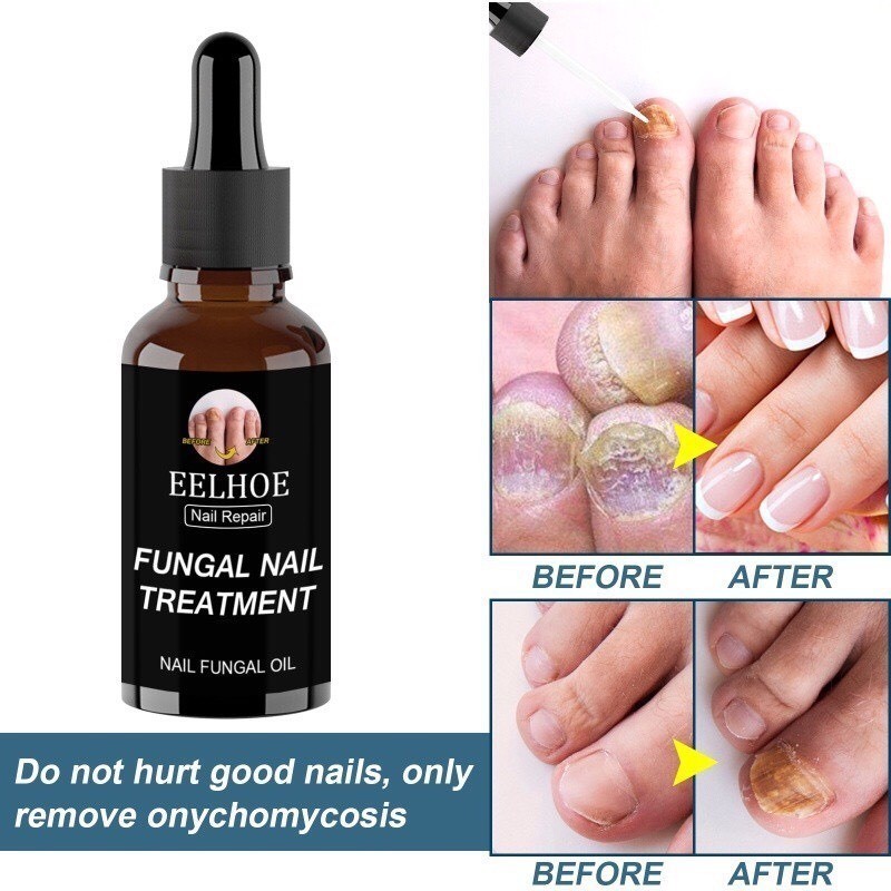 Serum Nấm Móng Thảo Dược Eelhoe Hoa Kì - Thảo Dược Tinh Khiết Dưỡng Móng Khôi Phục Mô Móng Eelhoe - SẢN PHẨM CHUẨN, CỰC KÌ TỐT, ĐẢM BẢO SỬ DỤNG ƯNG Ý, ĐƯỢC ƯA THÍCH TRÊN THỊ TRƯỜNG HIỆN NAY, ỦNG HỘ SHOP NHÉ