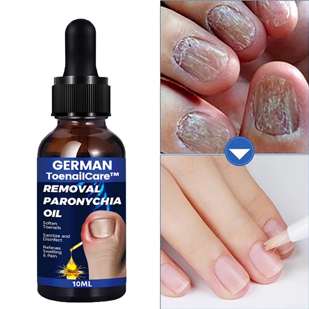 Serum Loại Bỏ Nấm Móng German Removal Paronychia - Tinh Chất Kháng Khuẩn Hỗ Trợ Phục Hồi Móng Và Bảo Vệ Móng - SẢN PHẨM CHUẨN, CỰC KÌ TỐT, ĐẢM BẢO SỬ DỤNG ƯNG Ý, ĐƯỢC ƯA THÍCH TRÊN THỊ TRƯỜNG HIỆN NAY, ỦNG HỘ SHOP NHÉ