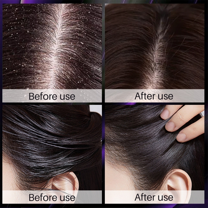 【Seasonal Sale】 Onion Shampoo For Prevent Hairloss And Deep Cleansing Sclap Hair Growth Shampoo Rose