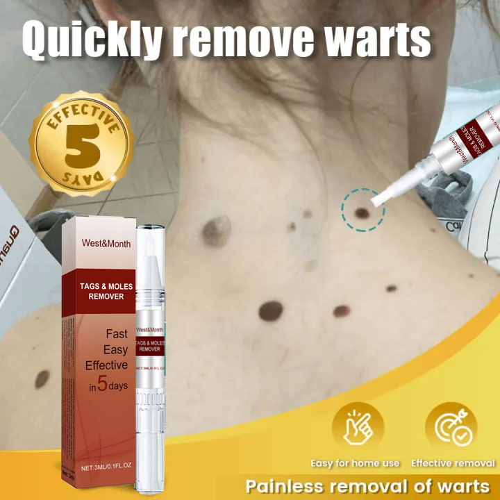  TAGS&MOLES REMOVER Gel Tẩy nốt ruồi mụn cóc ,tàn nhang ,mụn thịt  mắt cá hiệu quả 