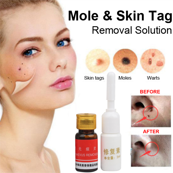 Mole Remover Set Skin Care Tags Warts Removal Repair Solution Kit
