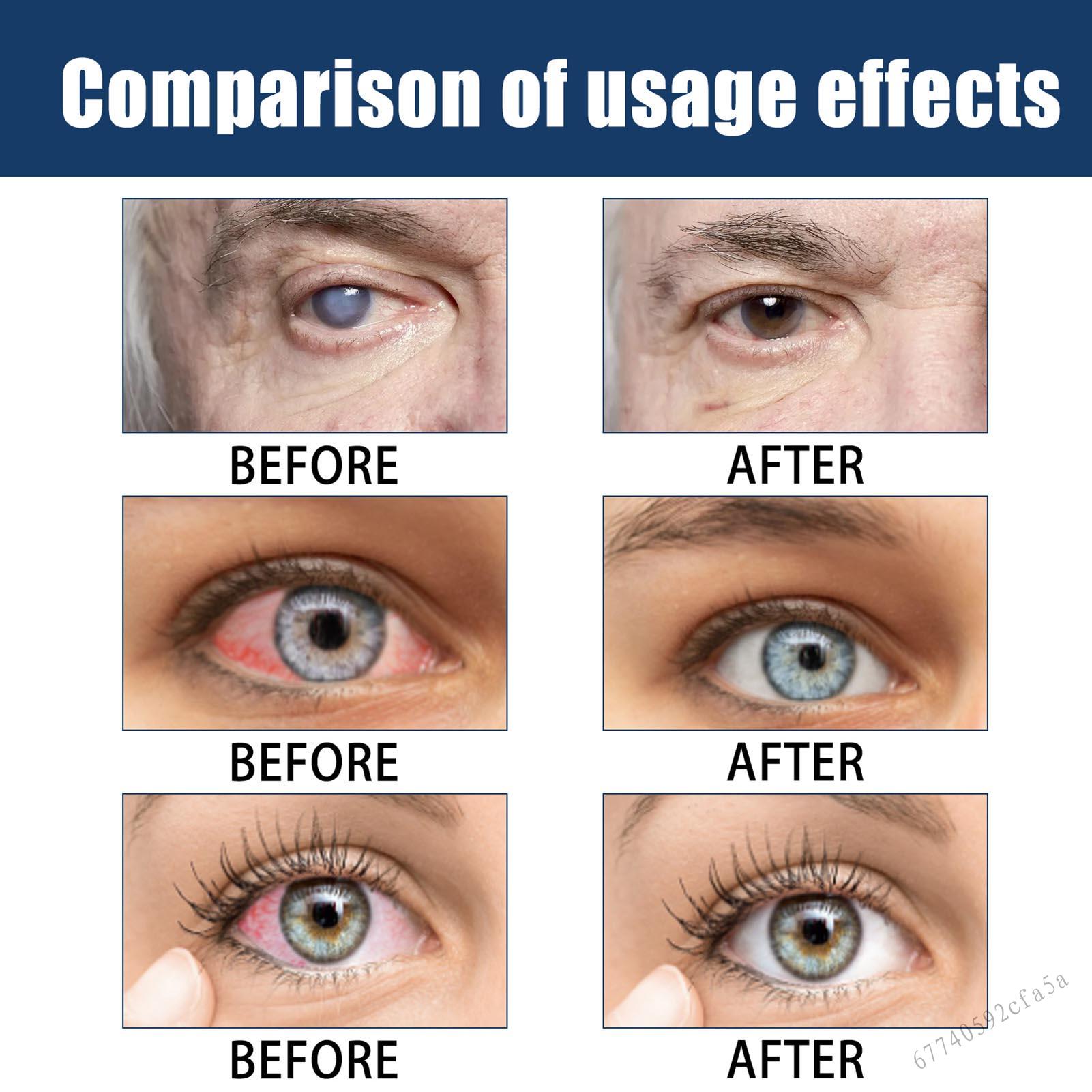 Dry Eye Therapy Eye Drops Herbal Extract Gentle Formula Eye Drops for Women Men Eye Care Drops BND-V