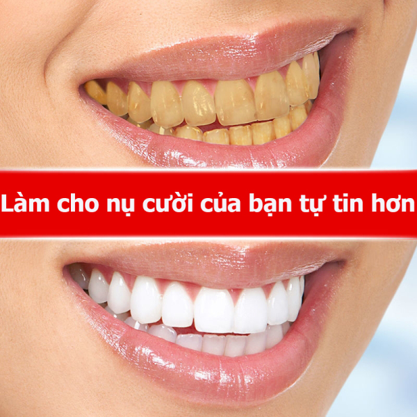 Tẩy trắng răng kem đánh răng vi sinh chăm sóc răng miệng giúp trắng răng, ngăn ngừa sâu răng,giảm Ố vàng, loại bỏ mùi hôi, chống sưng nướu dental,loại bỏ răng kết sỏi,loại bỏ mảng bám vết bẩn