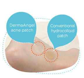 angel pimple patch
