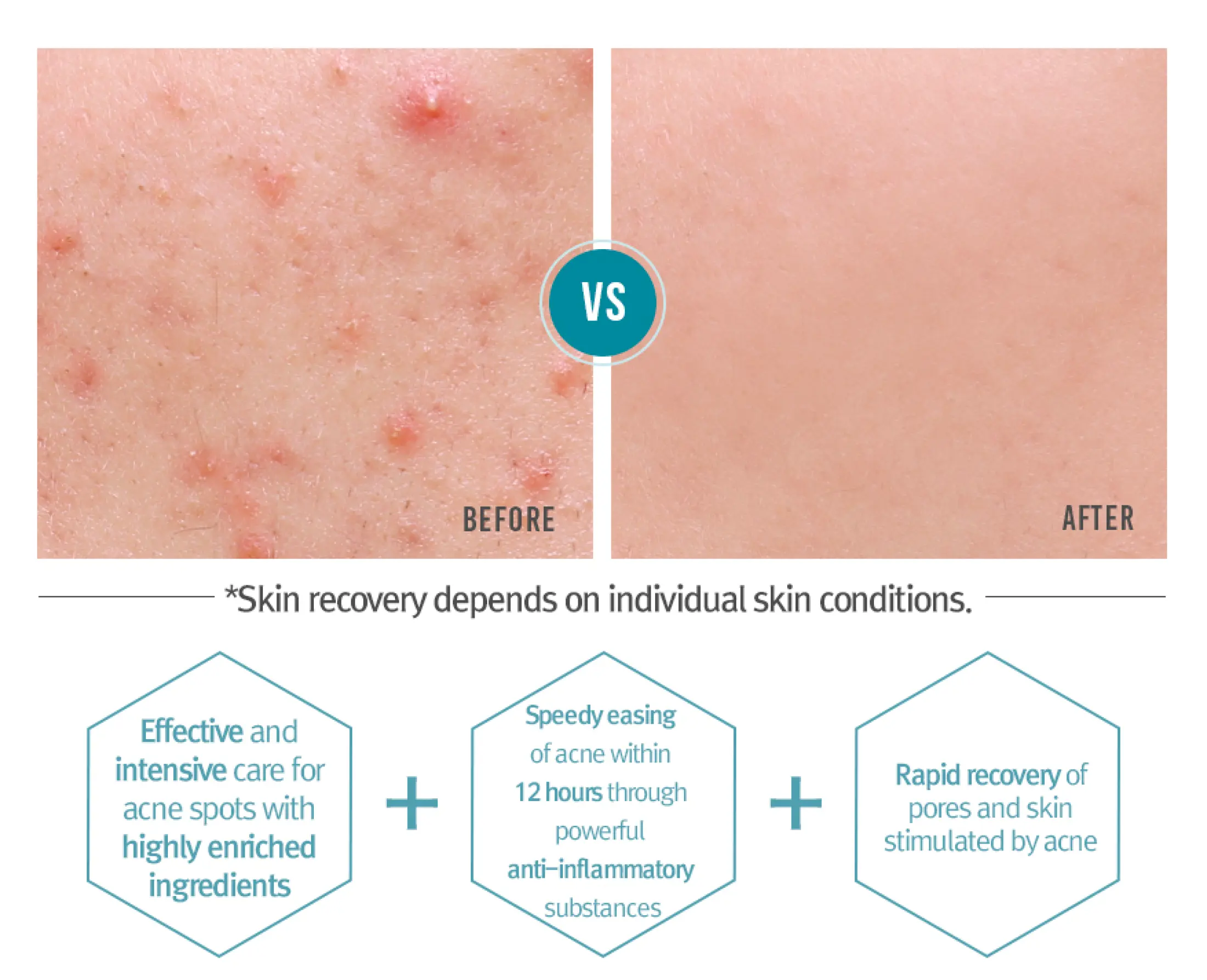 review pyunkang yul acne cream